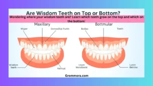 are-wisdom-teeth-on-top-or-bottom
