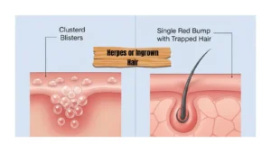 herpes-or-ingrown-hair